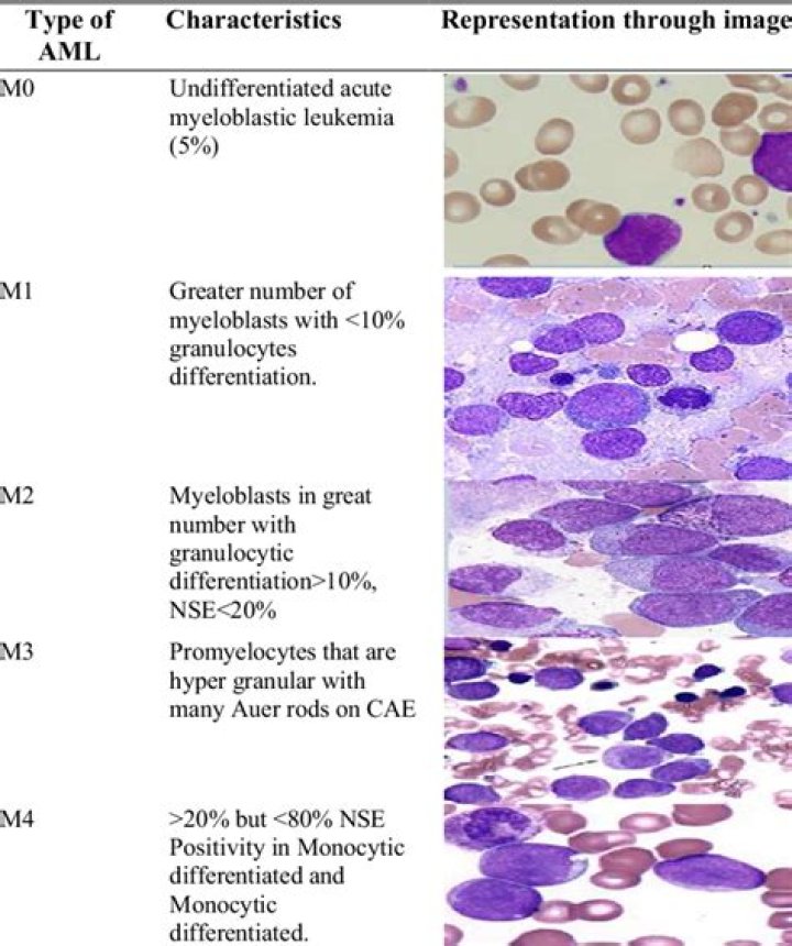 Is all leukemia fatal?