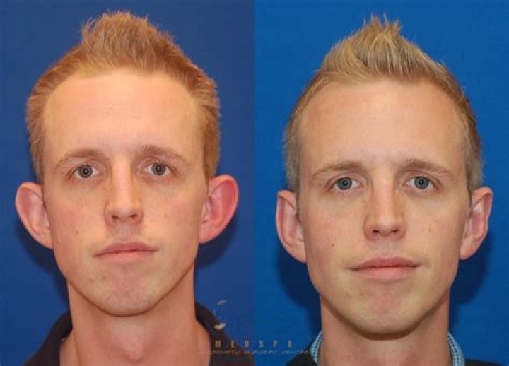 Is an otoplasty worth it?