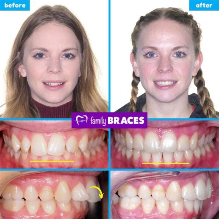 Is braces or Invisalign better for kids?