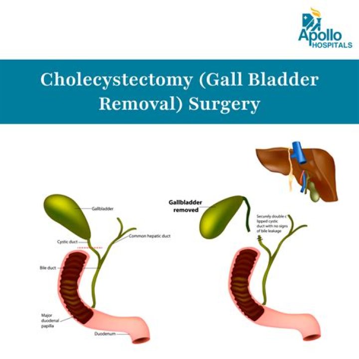 Is gallbladder removal minor or major surgery?