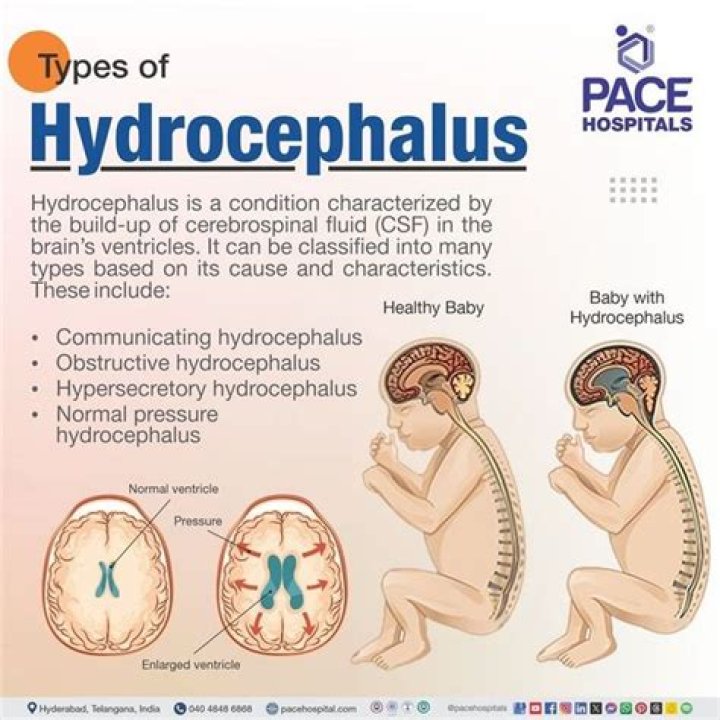 Is hydrocephalus considered a birth defect?