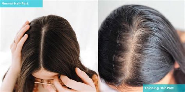 Is it normal to have less hair on your crown?