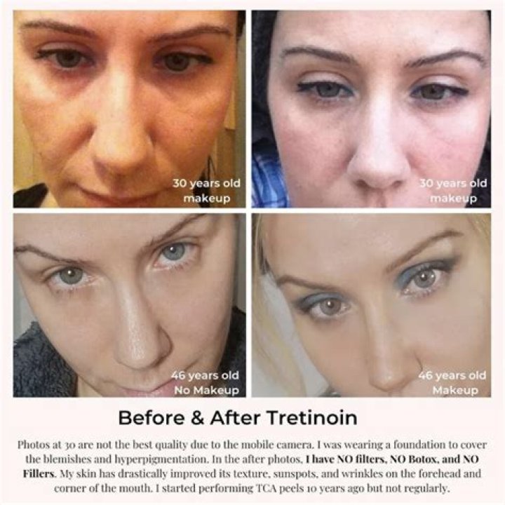 Is it OK to use tretinoin for years?
