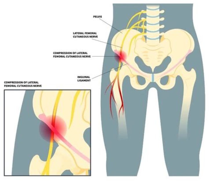 Is sitting good for meralgia paresthetica?