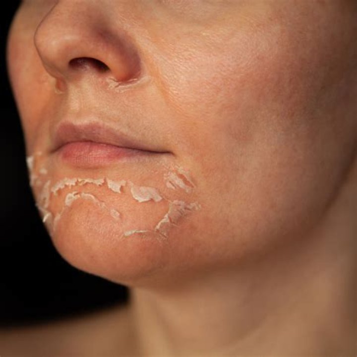 Is skin peeling good for eczema?