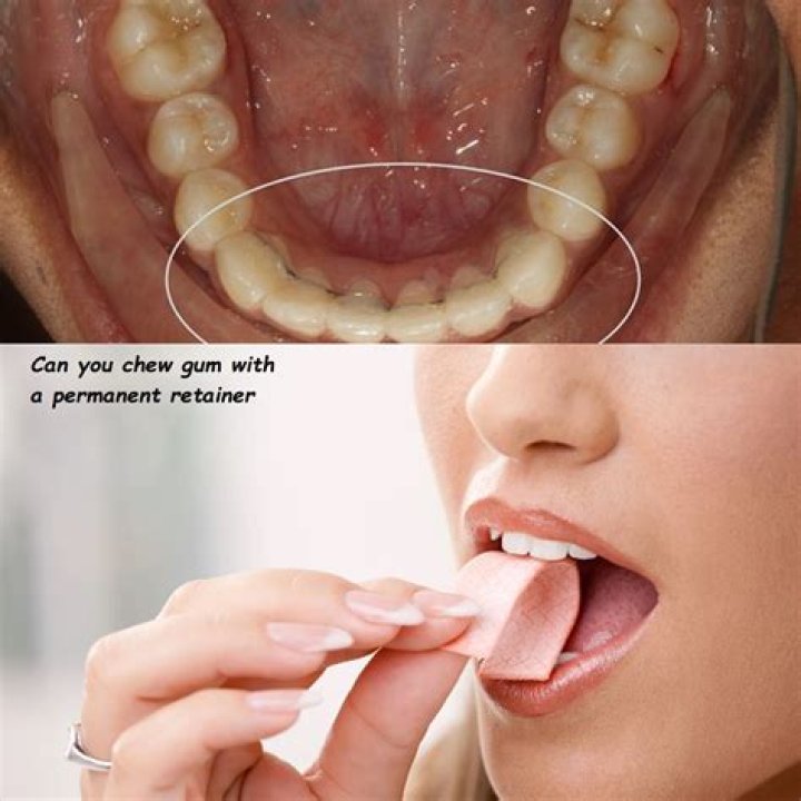 Should you chew gum after eating?