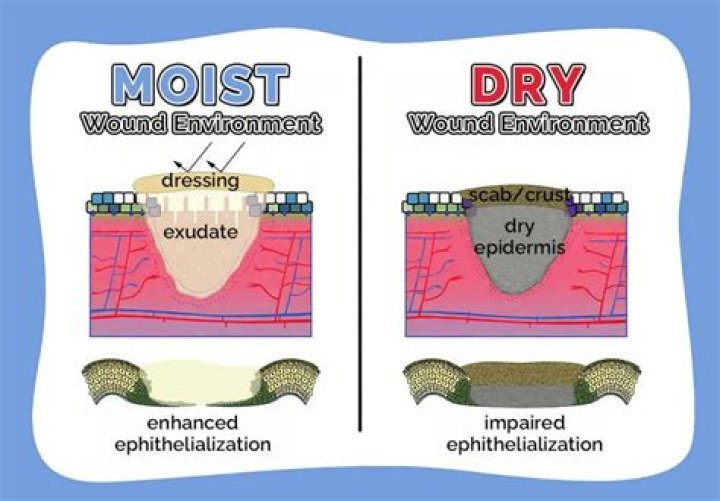 Should you keep eczema dry or moist?