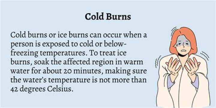 Should you put cold water on a burn?