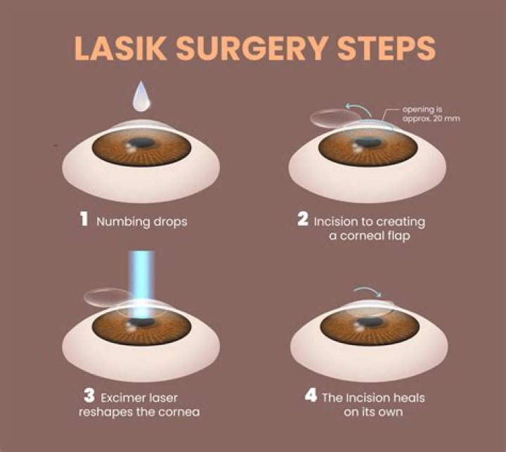 What age is recommended for LASIK?