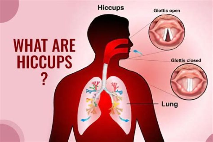 What are hiccups called in America?