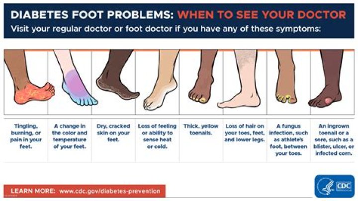 What are the signs of diabetic feet?
