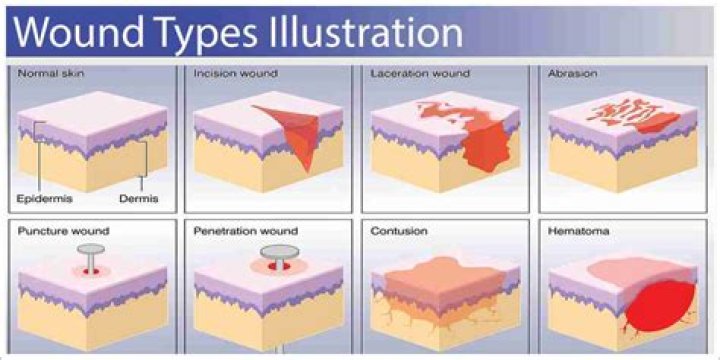 What are the types of wounds?