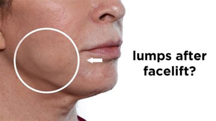 What causes lump inside cheek?