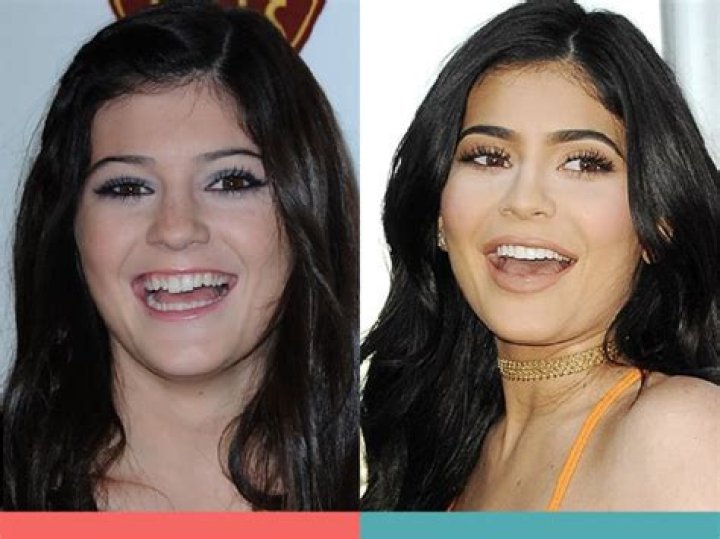 What celebrities have had a BBL?