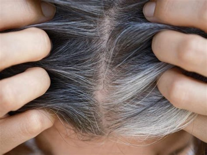 What deficiency causes white hairs?