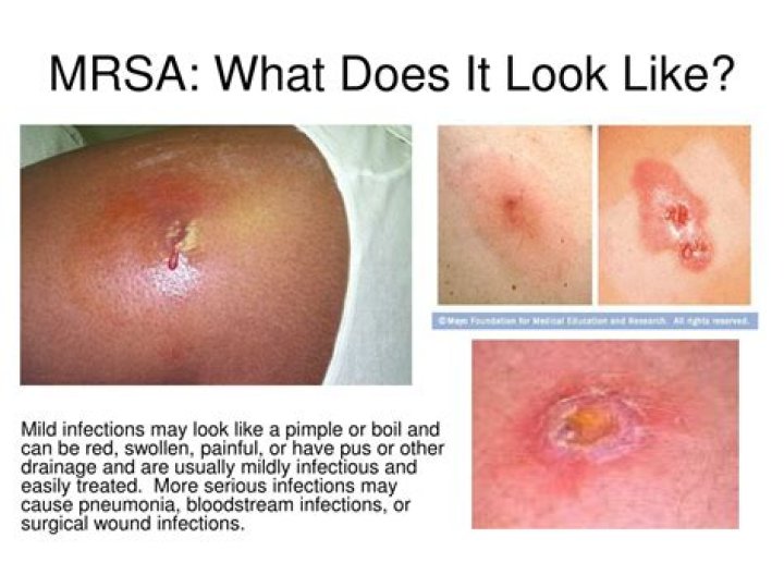 What dies MRSA look like?