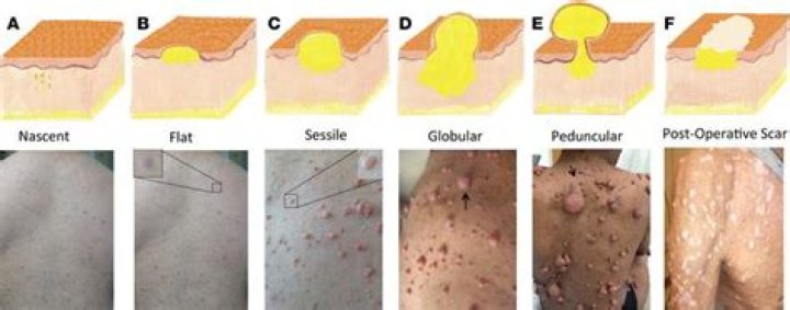 What do neurofibromas look like at first?