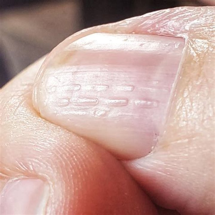 What do vertical ridges in toenails mean?