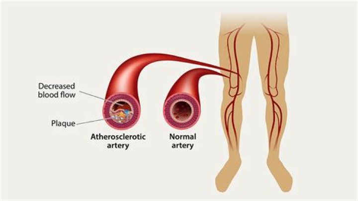 What does a blocked artery in your leg feel like?