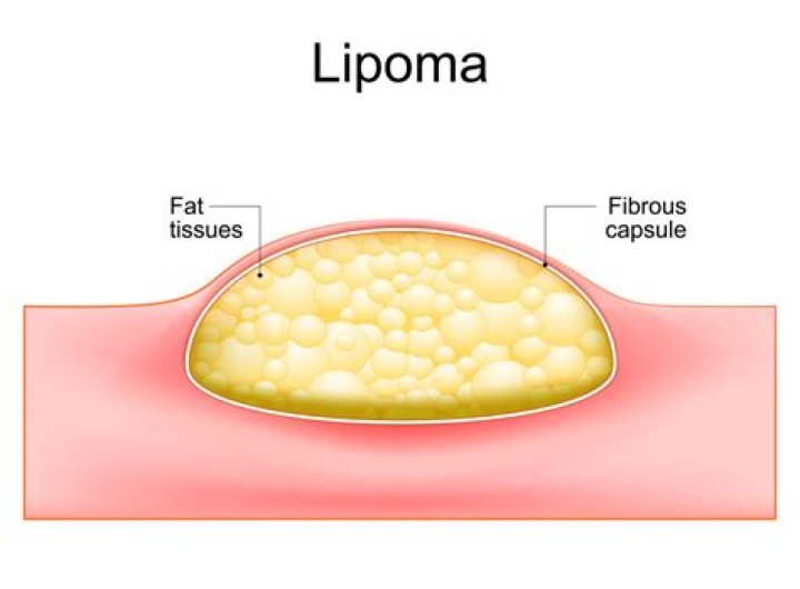 What does a breast lipoma feel like?