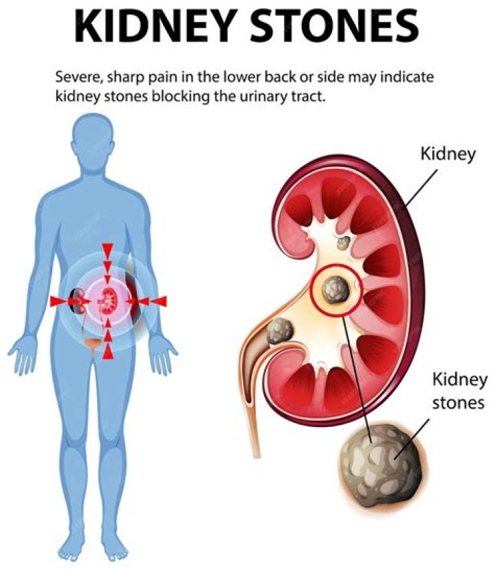 What does a kidney stone feel like for a woman?
