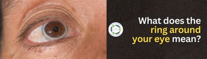 What does a ring around your eye mean?