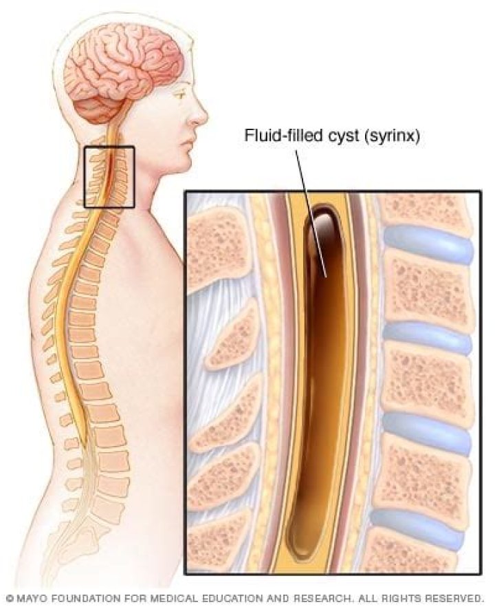 What does Hydrosyringomyelia mean?