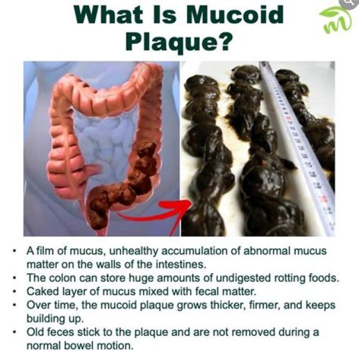 What does mucoid plaque look like?