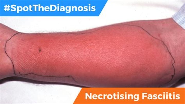 What does necrotizing skin look like?