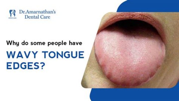 What does ridges on your tongue mean?