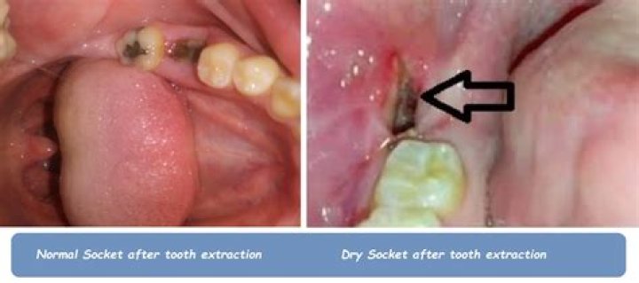What does salt water do for tooth extraction?