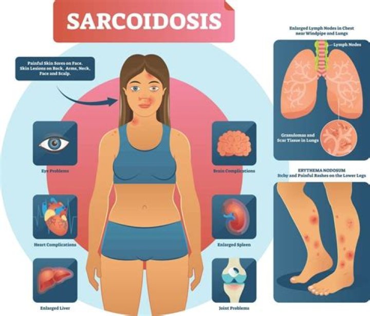 What does sarcoidosis look like on a CT scan?