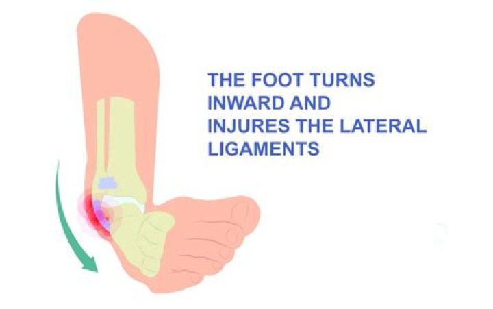 What happens if a torn ligament in ankle goes untreated?