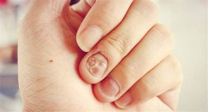 What happens if you bite your nails too much?
