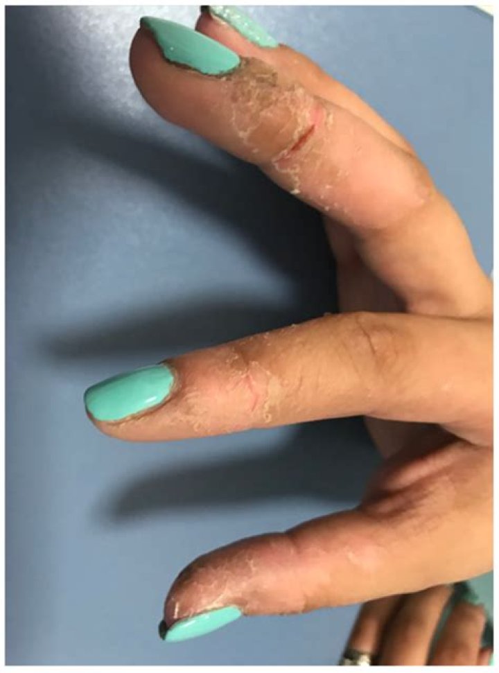 What happens if you get lacquer thinner on your skin?