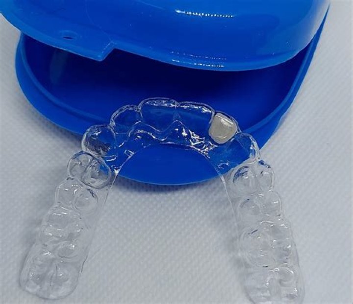 What is a glued retainer?