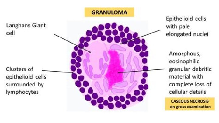 What is a granuloma?