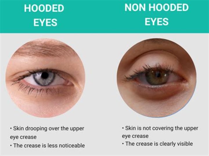 What is a hooded eyelid?