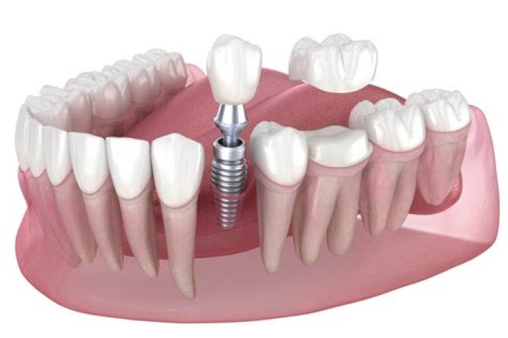 What is better crowns or implants?