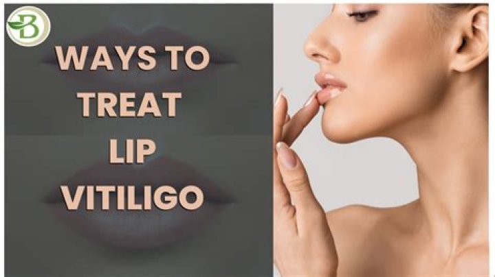 What is lip vitiligo?