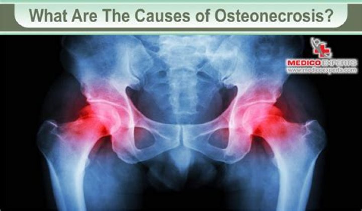 What is osteonecrosis pain like?