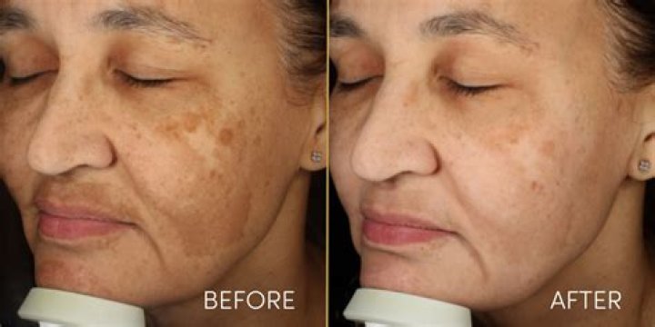 What is the best treatment for pigmentation on the face?
