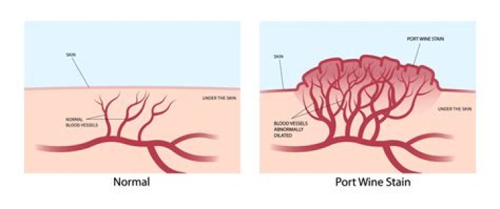 What is the difference between a port-wine stain and a hemangioma?