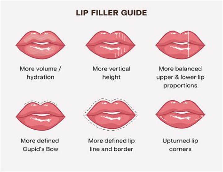 What is the new lip filler called?