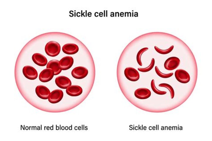 What is the relationship between malaria and sickle cell anemia quizlet?