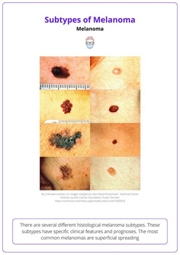 What is the size of melanoma?