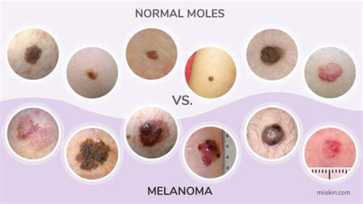 What looks like melanoma but isn t?