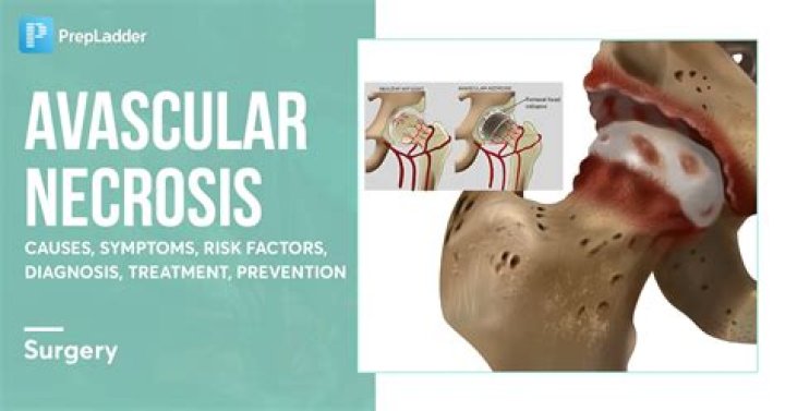 What medications cause avascular necrosis?