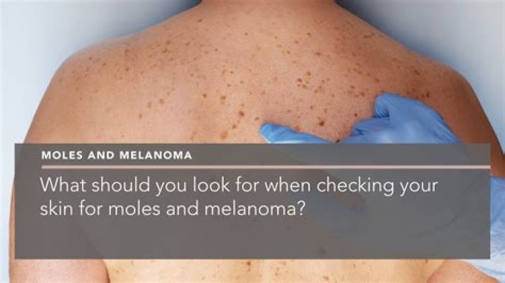 What moles should be checked?