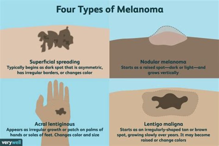 What organs does melanoma affect?